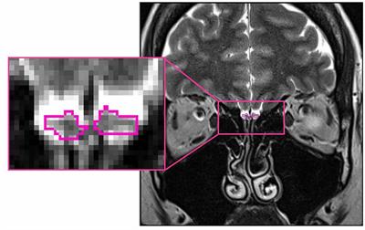 Pre-aging of the Olfactory Bulb in Major Depression With High Comorbidity of Mental Disorders